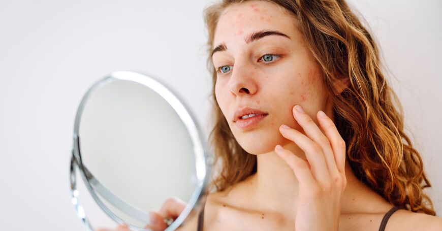 Nuori nainen tutkii akneihoa peilistä.