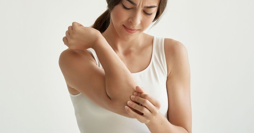 hajusteallergiasta kärsivä nainen levittää hoitovoidetta ihottumaan