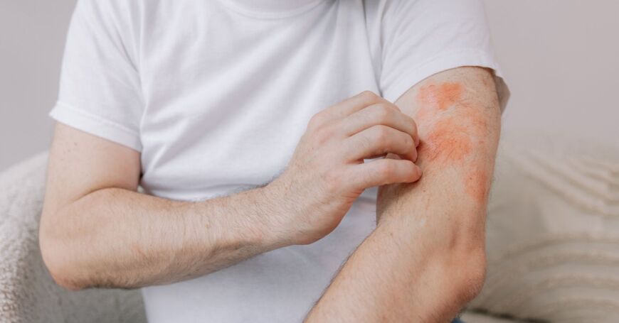 käsivarressa on psoriasiksen aiheuttamaa ihottumaa
