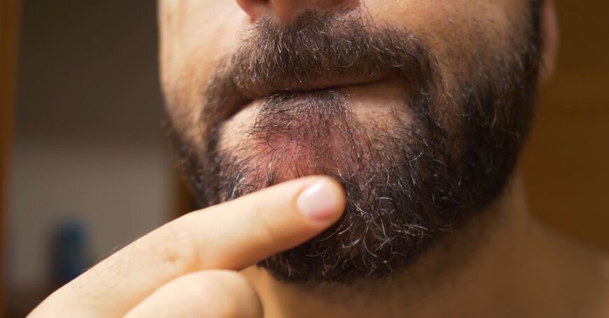 Tali-ihottuma eli seborrooinen ekseema on ihosairaus, jossa etenkin karvaisilla alueilla olevat talirauhaset tuottavat talia ylimäärin.